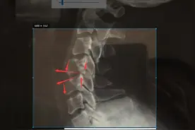 一男子颈椎按摩后，就开始头晕了，到底是怎么回事？