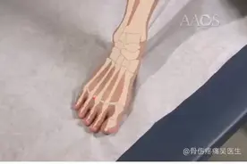 趾间神经瘤封闭术视频封面