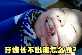 小孩换牙恒牙长不出来咋办？家长花10块钱给做个小手术，立马好了