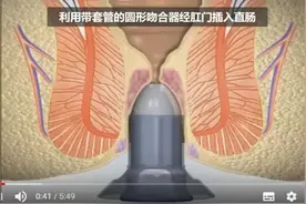 痔疮PPH手术是怎样做的？视频封面