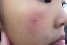 晴宝被马蜂蛰了，网友说个方法应急处理，没想到消肿了。