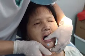 小伙实拍在诊所制作全口假牙边缘塑型，有效提高吸附力！视频封面