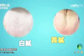 身体沉重也是湿气重的表现？专家总结了八种湿气重的症状，看看吧视频封面