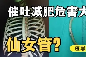 吃播与催吐，行业乱象，谈催吐对身体的损伤，医学博士科普视频封面
