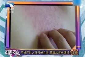 女子产后入住月子会所，在做过一些理疗项目后，身上长满红疙瘩