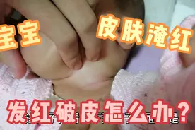 四个月宝宝脖子，腋下，腹股沟皮肤淹了，发红又破皮怎么办？心疼视频封面