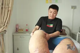 象腿男孩！28岁男孩被蚊子叮出象皮病，多次轻生终寻得良医视频封面