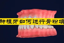 骨粉填充的原理来咯，看看种植牙牙槽骨萎缩如何处理吧视频封面