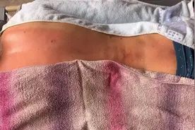 督脉灸做完后的注意事项