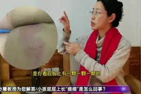 小孩屁屁上长“痘痘”是怎么回事？看看这个小病人的就诊治疗过程