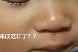 宝宝半夜摔得鼻青嘴肿，都怪我太大意！！