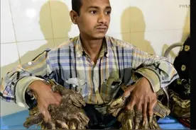 现实版树人！手脚长满肉疣25次手术切除未根治，男子双手犹如树根视频封面