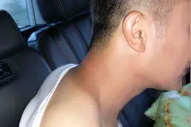 夏天脖子晒黑了怎么办？教你修复的小窍门，皮肤快速恢复白皙如雪