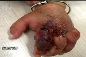 小孩子被蚊虫叮咬后手指竟然肿大发黑！原因竟然是这样！视频封面