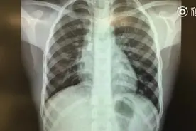 视频记录支气管镜取出儿童呼吸道异物，家长们一定要看好孩子啊！