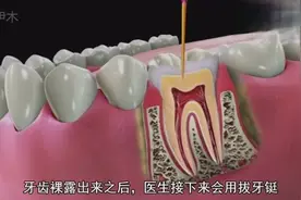 拔牙的过程是怎样的？3D演示拔牙全过程，难怪拔牙这么疼！视频封面