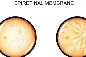 眼部有黄色的物质有点慌？医生教你怎么做视频封面