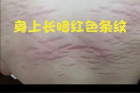 身上不痛不痒的   暗红色条纹   是什么？视频封面