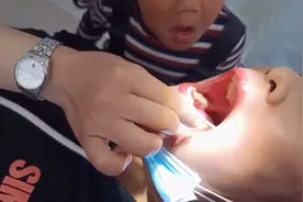 媳妇嘴里长了一颗智齿受不了了，看医生怎么说的