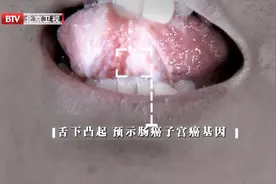警惕！舌下出现这种凸起，可能预示携带肠癌、子宫癌基因视频封面