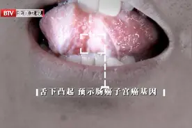 警惕！舌下出现这种凸起，可能预示携带肠癌、子宫癌基因视频封面