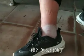 蚊子毒起来真可怕，男友的腿被蚊子咬后，肿的很大很硬