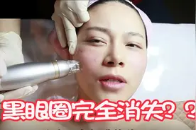 在韩国做了微针皮肤管理+祛黑眼圈，黑眼圈消失了斑也变浅了视频封面
