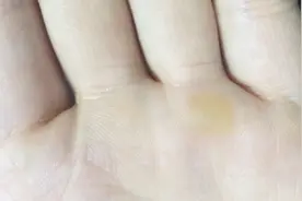 还再苦恼手上脚上的老茧吗？每天抹点它，一周轻松去除老茧！