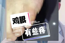 脚上长鸡眼，有些疼，怎么办？#鸡眼 #跖疣 #医学科普 @DOU+小助手视频封面