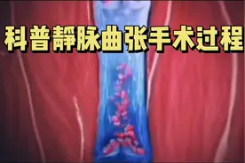 科普静脉曲张手术过程，带你了解静脉曲张！视频封面