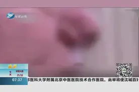 78岁大爷鼻子越来越长，差点成“大象鼻”，竟是因为他有这个习惯