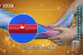 崴脚，扭伤后，千万不要按摩，处理不当可能导致猝死风险！视频封面