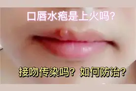 口唇水疱是上火吗？接吻传染吗？如何防治？视频封面