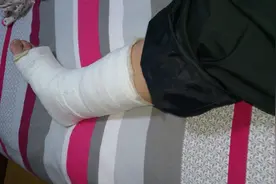 治疗骨折时，打钢钉与石膏的区别是什么？背后大有讲究！视频封面