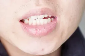 上嘴唇密密麻麻的白点是什么原因？视频封面