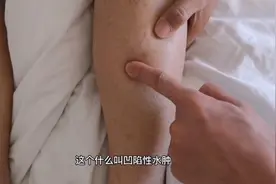 胖胖的小脚丫，原来都是水肿惹得祸！