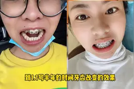 90后二胎妈妈实拍牙齿矫正换丝全过程，牙套6个月改变效果满意视频封面