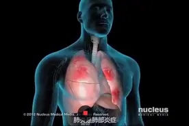 动画展示感染肺炎的症状及发病原因视频封面