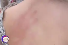 后背有个蚊子，让闺蜜帮忙拍一下子，然后就出现了这么大个红手印