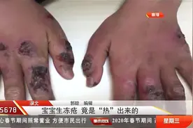 宝宝生冻疮，双手红肿溃口遍布，医生说出冻疮起因让人意外视频封面