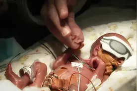 24周大的早产儿一步步长大全过程，这么小一个，真是不容易