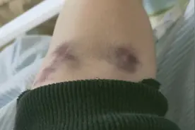 小妮的血液凝固了，扎了3针都抽不出血，有个好消息瞬间安慰