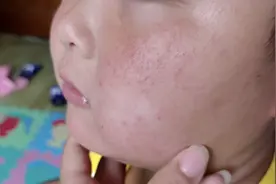 孩子脸上皮肤过敏，起了好多小红点点，改怎么办呢？视频封面