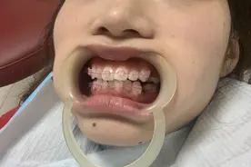 全网最详细戴牙套全过程！想做牙齿正畸的看过来！