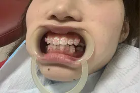 全网最详细戴牙套全过程！想做牙齿正畸的看过来！