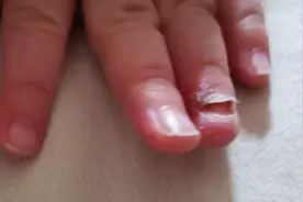 不小心关门把十个月宝宝手指夹了，指甲盖都脱了，大家要看好宝宝视频封面
