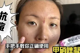 涂甲硝唑凝胶烂脸的痤疮姑娘们注意啦，手把手教你怎么正确使用