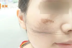 成都一女子吃火锅抽中美容卡 到店美容护理后脸肿了视频封面