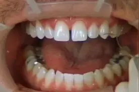 牙齿贴片完整版来咯，牙齿贴片既可以保护牙齿又美观。明星项目呦视频封面