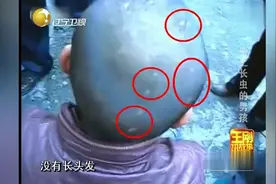 男孩头顶竟长出了虫子，真相会是怎样呢，太令人震惊了！